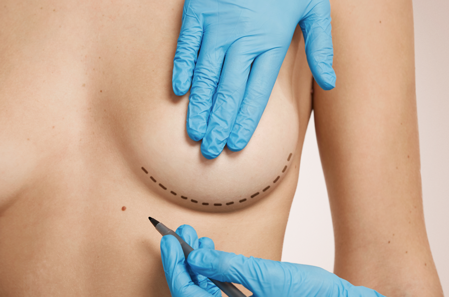 醫師在胸下緣畫線標記隆乳切口位置