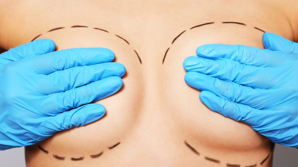 醫美隆乳手術的前置準備示意圖，展示醫師戴著藍色手術手套的雙手置於女性胸部上，皮膚表面畫有黑色虛線的手術設計標記。