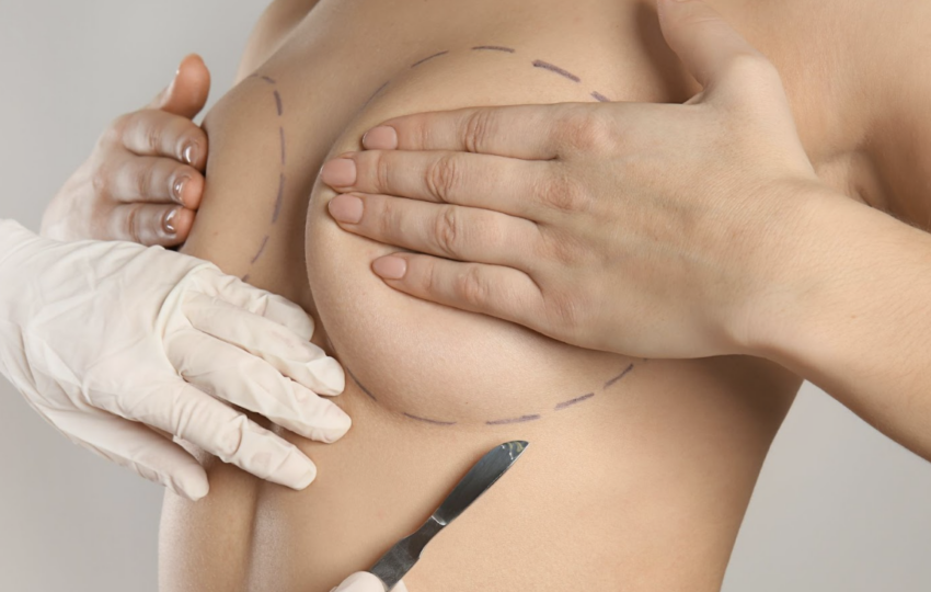 醫師為患者胸部進行精細的術前測量與標記，確保隆乳手術後的左右對稱與美觀