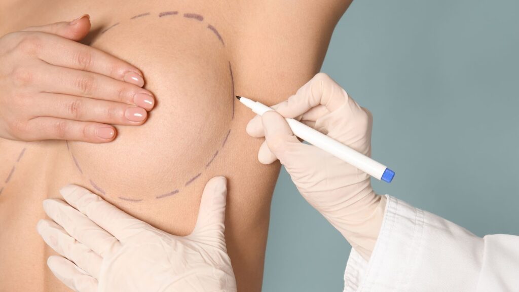 整形外科醫師在患者胸部使用手術記號筆進行隆乳術前劃線評估