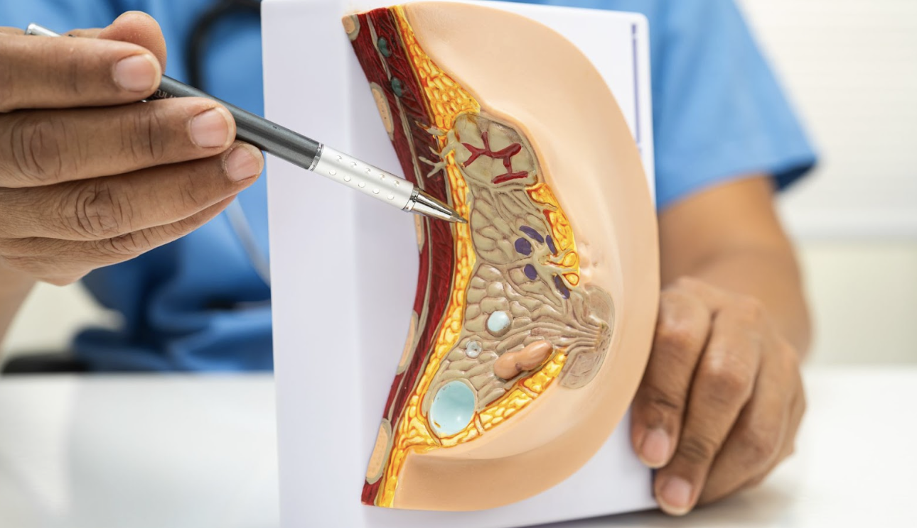 醫師使用筆尖指向女性乳房組織解剖模型，向患者解釋內部構造、腺體位置以及隆乳手術的植入層次