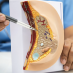 醫師使用筆尖指向女性乳房組織解剖模型，向患者解釋內部構造、腺體位置以及隆乳手術的植入層次