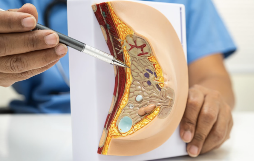 醫師使用筆尖指向女性乳房組織解剖模型，向患者解釋內部構造、腺體位置以及隆乳手術的植入層次